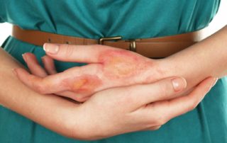 oparzenia pierwsza pomoc